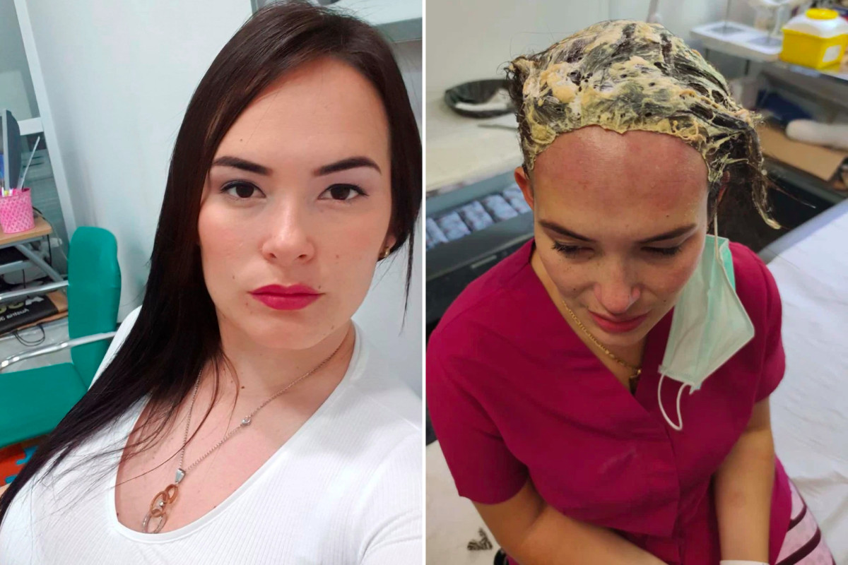 Mujer sufre quemaduras graves en el cuero cabelludo por ataque químico